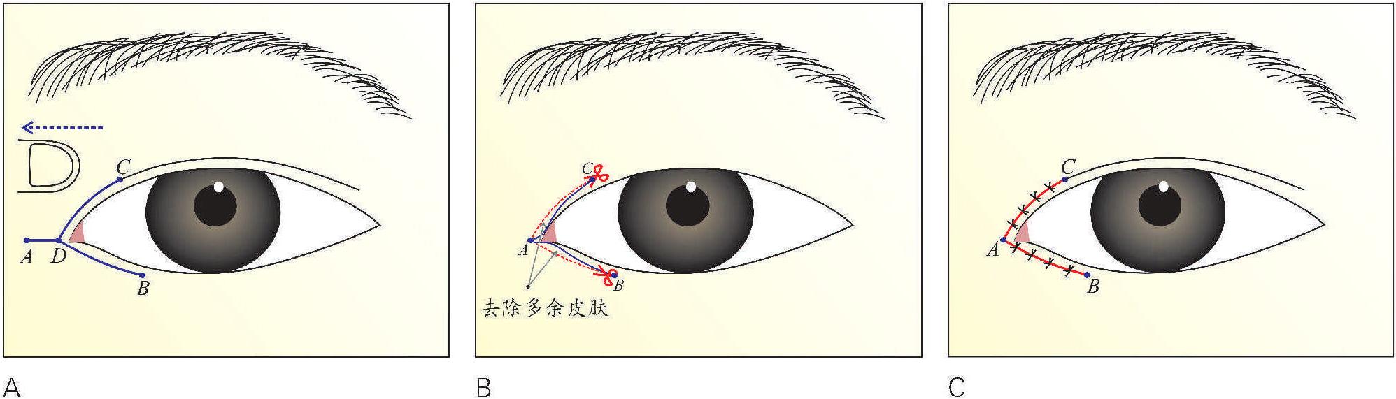 Y-V法